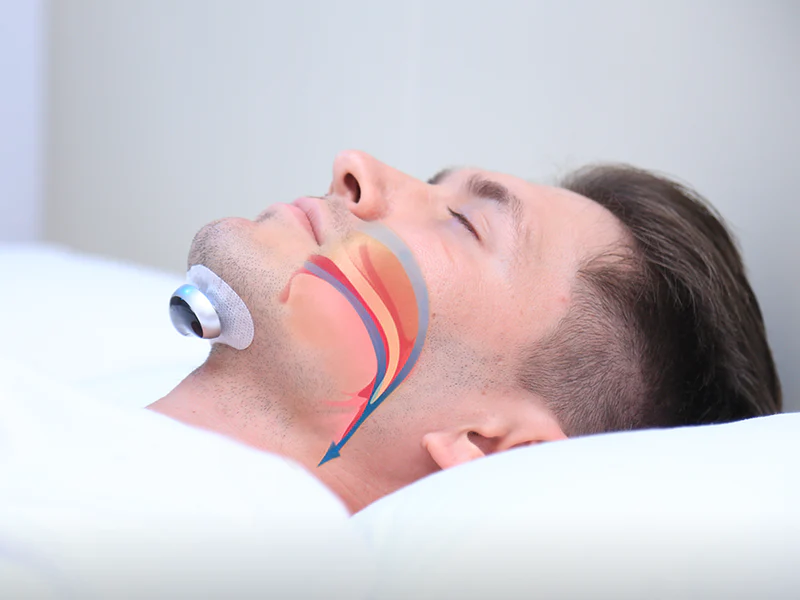 Comfortable Anti-Snoring Device - QuietWave - Image 8